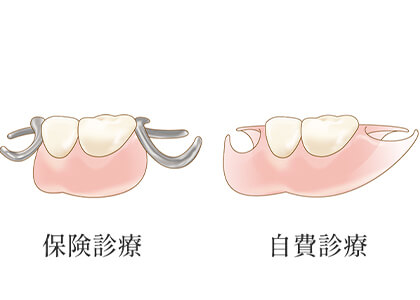 保険の入れ歯・自費の入れ歯の違い